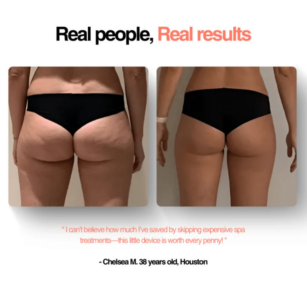 GlowFit™ Cellulite Massager