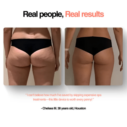 GlowFit™ Cellulite Massager