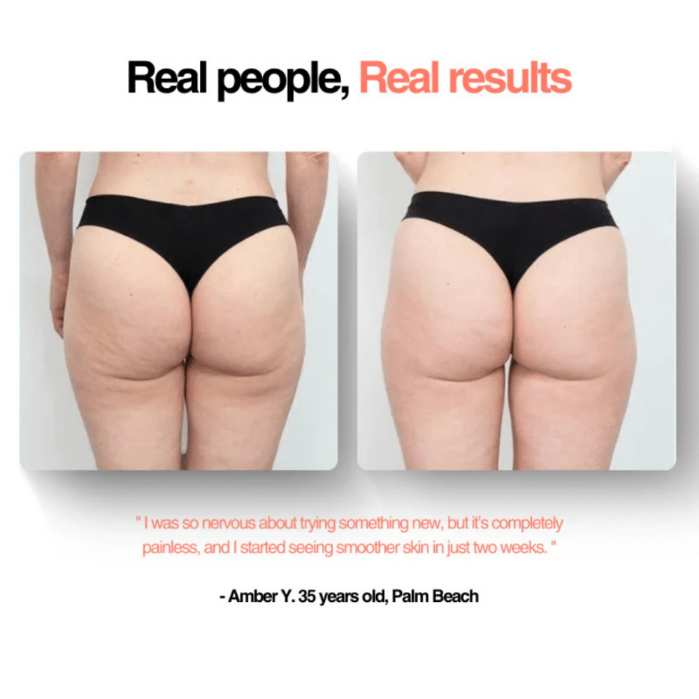 GlowFit™ Cellulite Massager