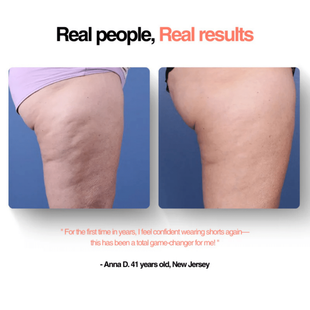 GlowFit™ Cellulite Massager