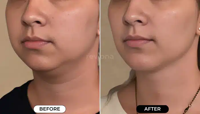 ContourFlex in Massager Before and After